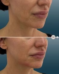 Mens Sana Clinique Filler mento