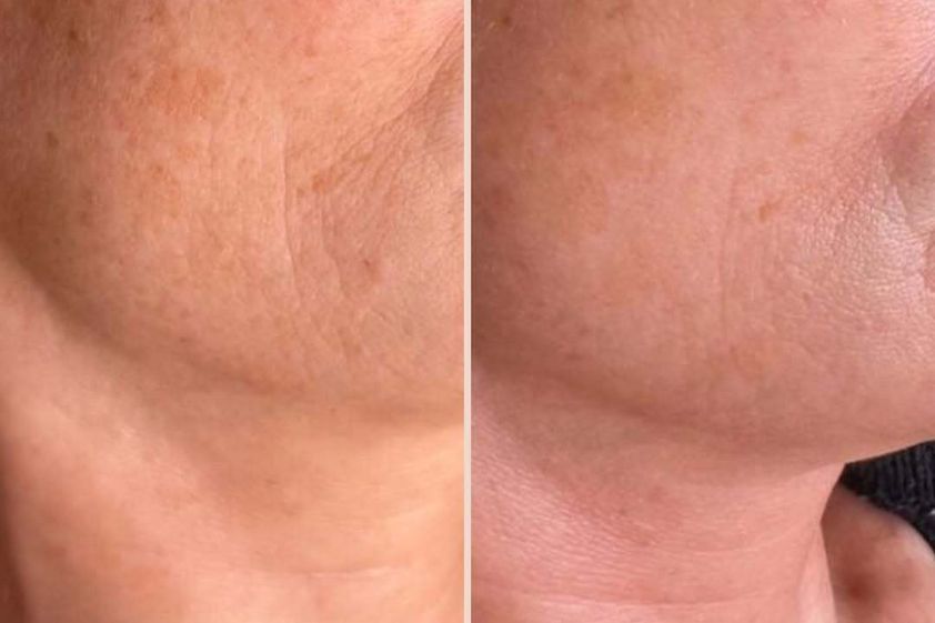 Biostimolazione prima e dopo - 878385