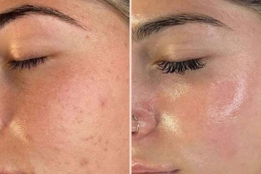 Biostimolazione prima e dopo - 878386