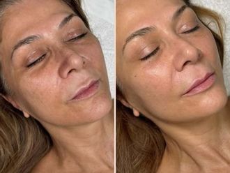 Biostimolazione prima e dopo - 878387