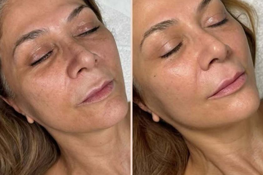 Biostimolazione prima e dopo - 878387