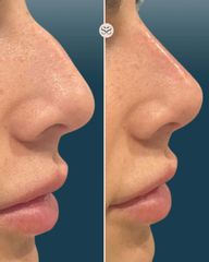 Mens Sana Clinique Rinofiller