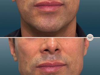 Filler prima e dopo - 878389