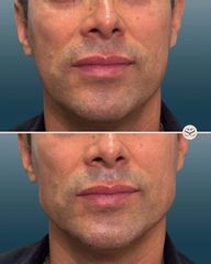 Mens Sana Clinique Filler