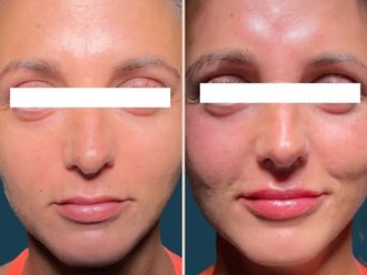 Filler prima e dopo - 878390