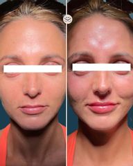 Mens Sana Clinique Filler viso