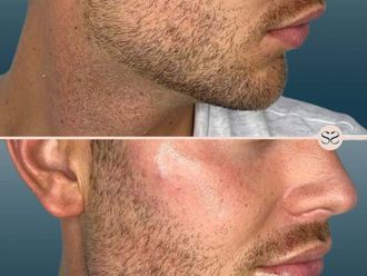 Filler prima e dopo - 878391