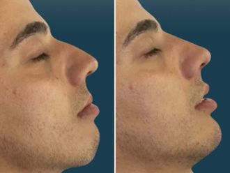 Filler prima e dopo - 878392