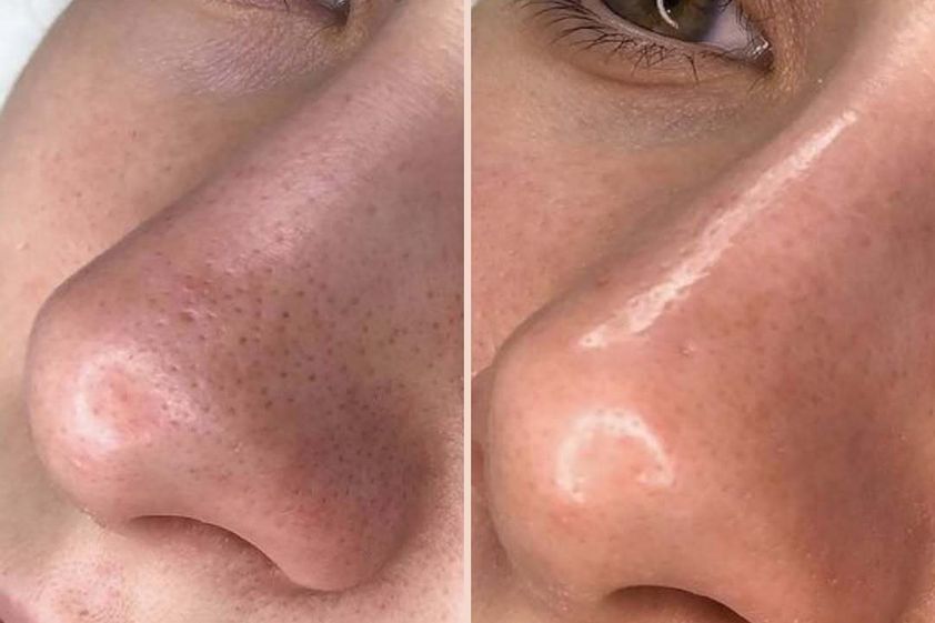 Biostimolazione prima e dopo - 878542