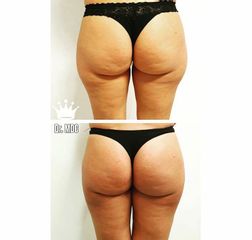 Gluteoplastia - Dott. Michele Di Candia