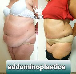 addominoplastica - Dott. Michele Di Candia