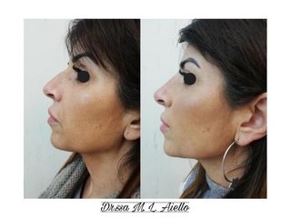 Rinofiler prima e dopo