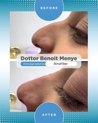 Venini Ventitre Medical Center Rinofiller Dottor Benoit Menye