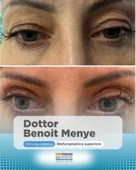 Venini Ventitre Medical Center Blefaroplastica superiore  Dottor Benoit Menye