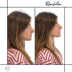 Venini Ventitre Medical Center Rinofiller Dott. Marco Borin