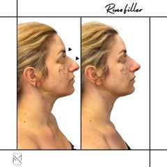 Venini Ventitre Medical Center Rinofiller Dott. Marco Borin