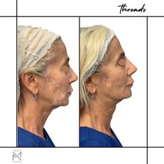 Venini Ventitre Medical Center Fili di trazione Dott. Marco Borin