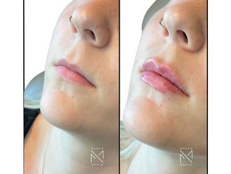 Filler labbra prima e dopo - 878832