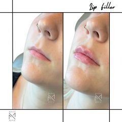 Venini Ventitre Medical Center Filler Labbra Dott. Marco Borin