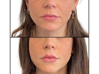 Filler labbra prima e dopo - 878833