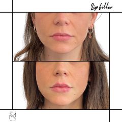 Venini Ventitre Medical Center Filler Labbra Dott. Marco Borin