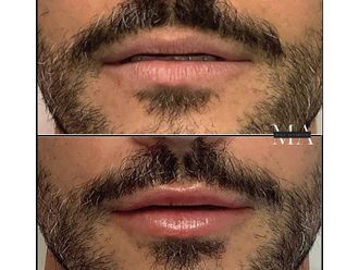 Filler labbra prima e dopo - 878834