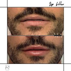 Venini Ventitre Medical Center Filler Labbra Venini Ventitre Medical Center