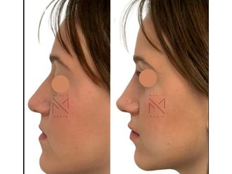 Filler prima e dopo - 878835