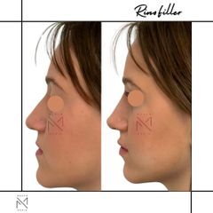 Venini Ventitre Medical Center Filler Dott. Marco Borin