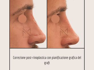 Rinofiller prima e dopo - 878836