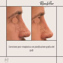 Venini Ventitre Medical Center Rinofiller Dott. Marco Borin