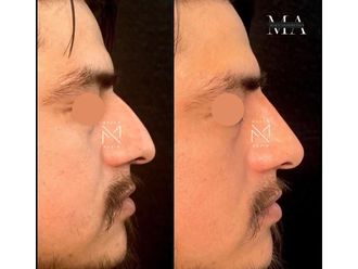 Rinofiller prima e dopo - 878837