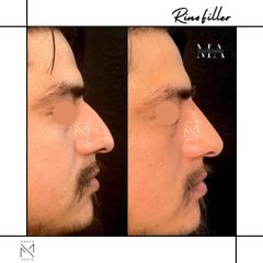 Venini Ventitre Medical Center Rinofiller Dott. Marco Borin