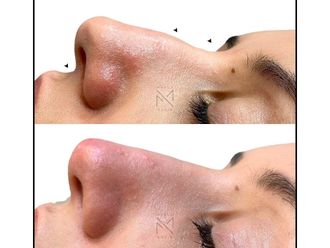 Rinofiller prima e dopo - 878838