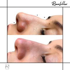 Venini Ventitre Medical Center Rinofiller Dott. Marco Borin