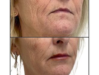 Filler labbra prima e dopo - 878847