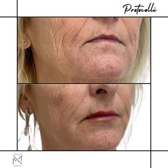 Venini Ventitre Medical Center Filler Labbra Dott. Marco Bori