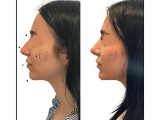 Rinofiller prima e dopo - 878848