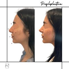 Venini Ventitre Medical Center Rinofiller Dott. Marco Borin