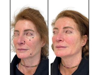 Acido ialuronico prima e dopo - 878849