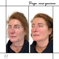 Venini Ventitre Medical Center Acido Ialuronico Dott. Marco Borin