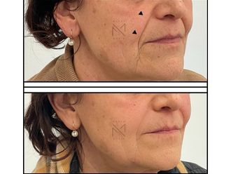 Acido ialuronico prima e dopo - 878850