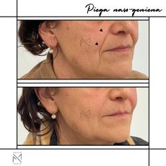 Venini Ventitre Medical Center Acido Ialuronico Dott. Marco Borin