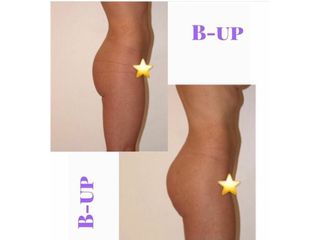Gluteoplastica - Dr. Raoul Novelli