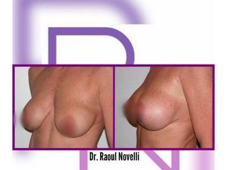 Mastoplastica additiva - Dr. Raoul Novelli