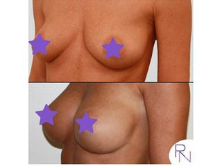 Mastoplastica additiva - Dr. Raoul Novelli