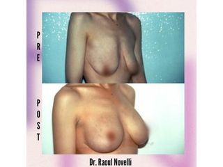 Mastopessi - Dr. Raoul Novelli