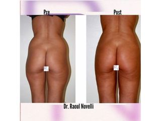 Liposcultura - Dr. Raoul Novelli