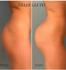 Filler glutei - Dr. Raoul Novelli