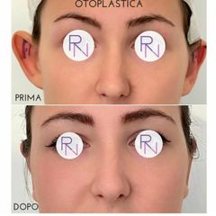 Otoplastica - Dr. Raoul Novelli